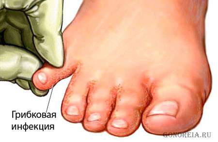 Грибок ног - симптоматика Как проявляет себя грибок ног