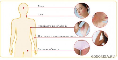 Атопический дерматит - очаги поражения Атопический дерматит